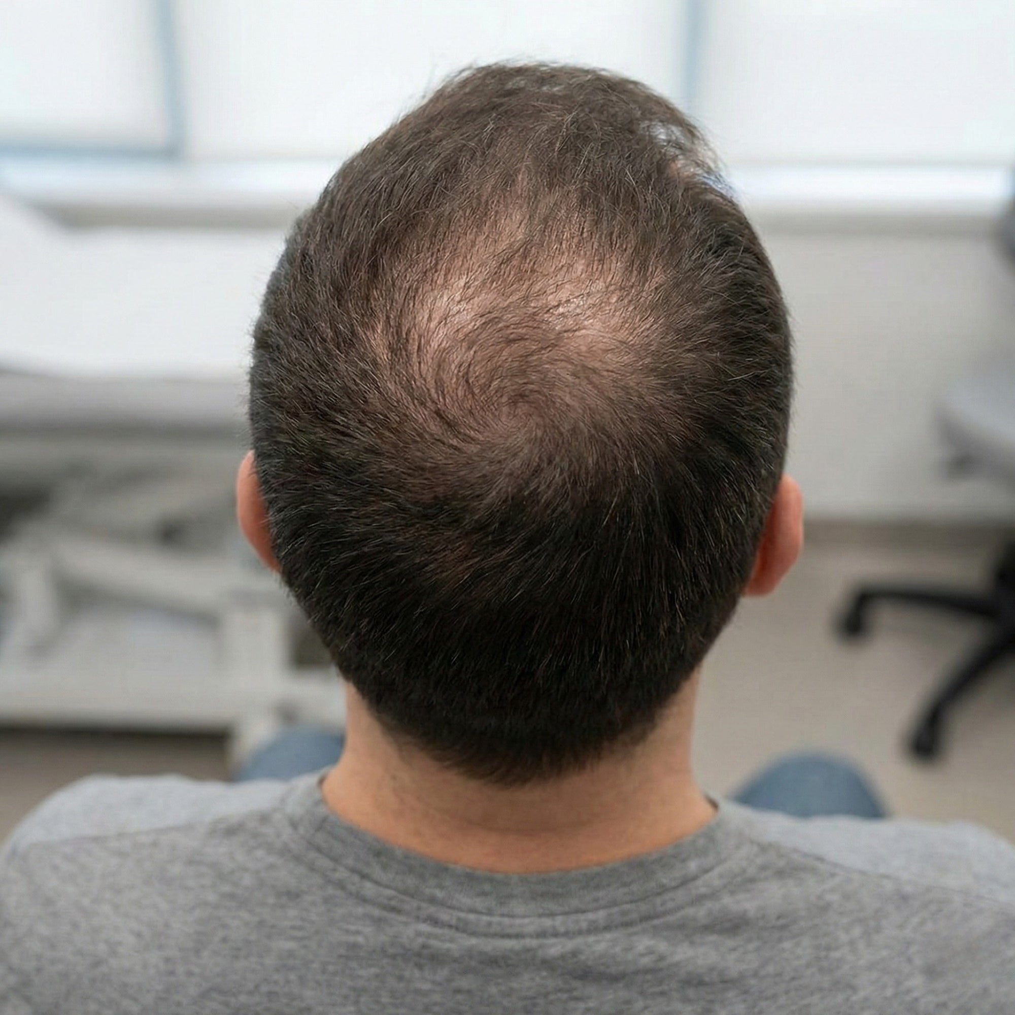 Man met geleidelijke haarverdunning bij de kruin